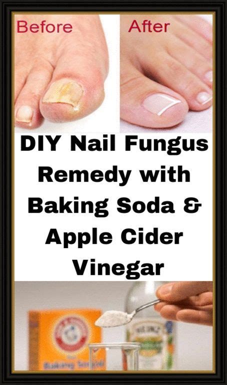 Diy Nail Fungus Remedy With Baking Soda And Apple Cider Vinegar Nail