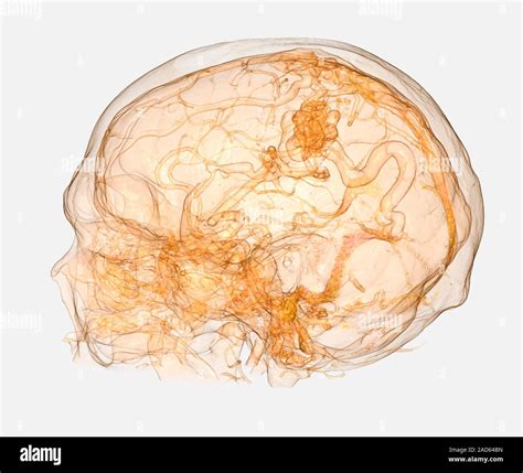 Cerebral Arteriovenous Malformation Illustration Based On A 3d