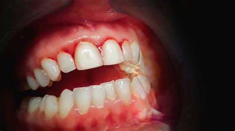 Causes And Symptoms Of Periodontal Disease And The Treatments Scottsdale Cosmetic Dentistry