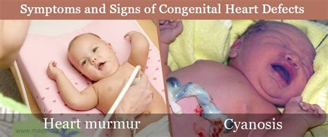 Congenital Heart Defects Symptoms