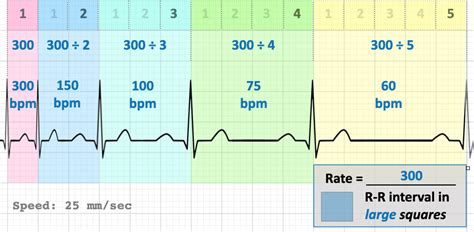 Ecg Calculation To Calculate Heart Rate From Ecg 8 Steps Pictures