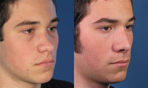 Rhinoplasty Surgery For Saddle Nose Deformity In San Diego Ca Dr