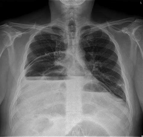 Preoperative X Ray X Ray Of The Chest Revealed Air Fluid Levels On