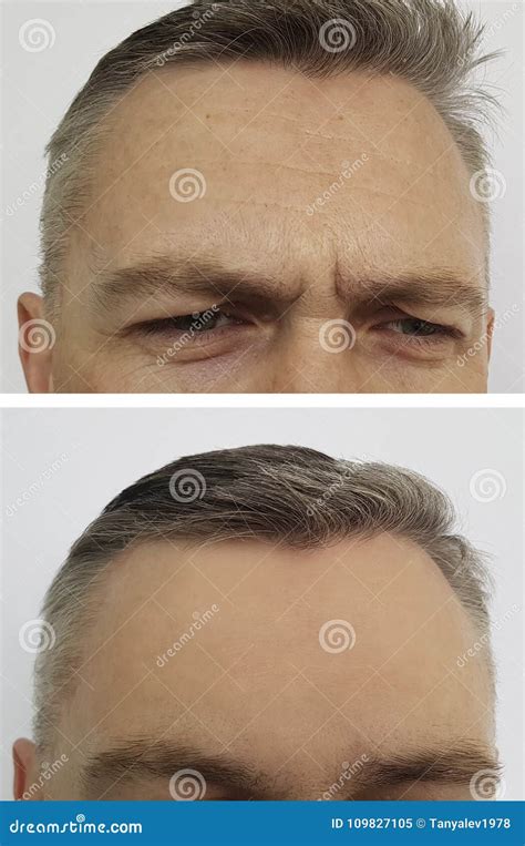 Arrugas Del Hombre En La Frente Antes Y Después Del Botox Imagen De