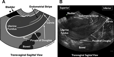 pelvic ideas in ultrasound sonography diagnostic medical hot sex picture