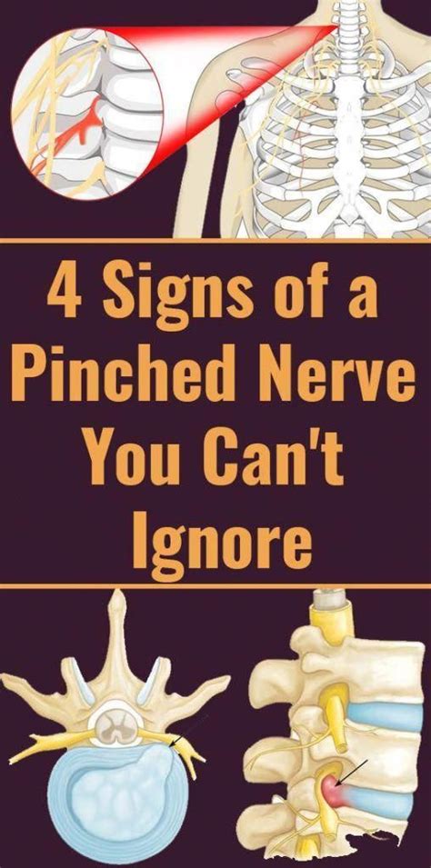 4 Crucial Signs Of A Pinched Nerve You Really Shouldt Ignore Healthy