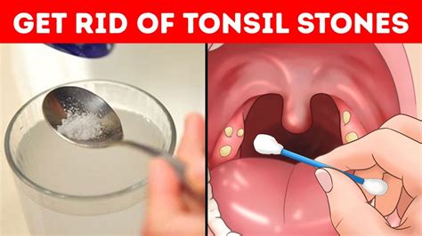 3 Best Ways To Get Rid Of Tonsil Stones Best Home Remedies For Tonsil