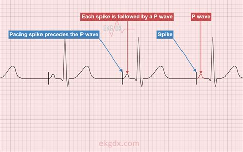 Electrocardiogram Showing Pacing Spikes With Abnormal P Waves Zohal