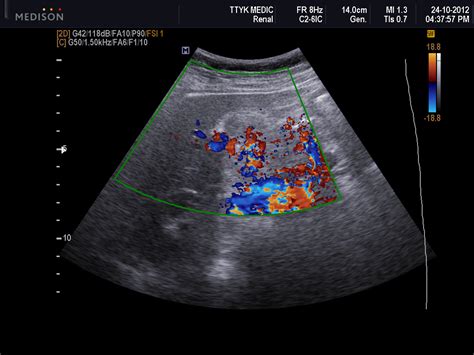 Vietnamese Medic Ultrasound Case 148 Gallbladder Cancer Post Trauma