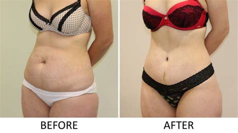 Tummy Tuck Before And After The Karri Clinic