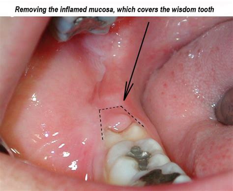 Treatment Of Pericoronitis Ralev Dental Clinic