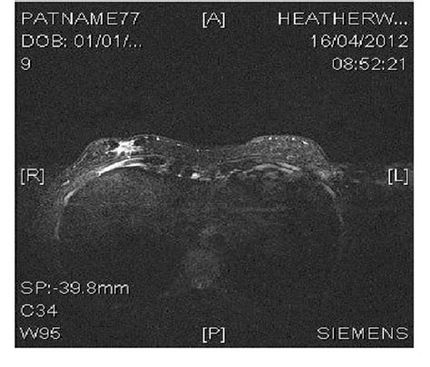 Figure 1 From Primary Ectopic Breast Carcinoma In A Supernumerary