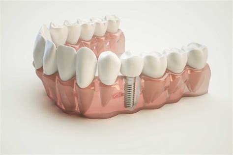 Everything You Need To Know About Dental Implants Prim Mart