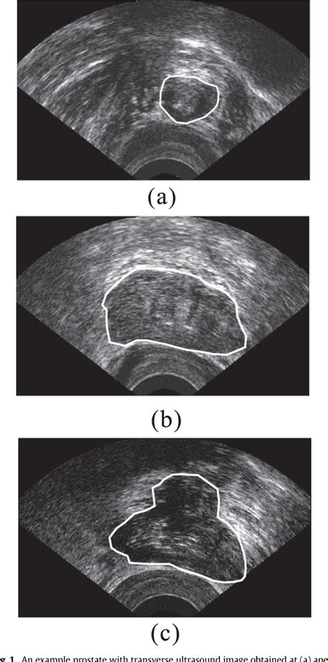 Figure 1 From Fully Automatic Prostate Segmentation From Transrectal