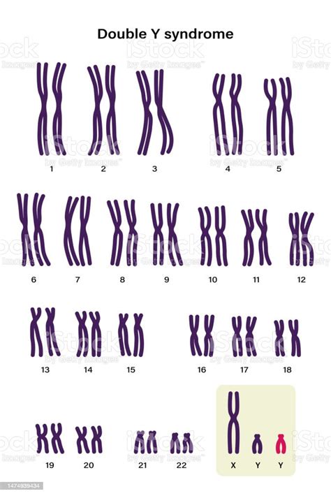 Human Karyotype Of Double Y Syndrome Xyy Male Has An Extra Y Chromosome Stockvectorkunst En Meer