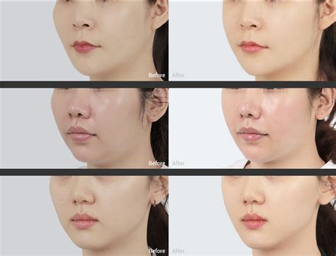 Korean Skin Injection In Id Hospital Petit Center Full Guide