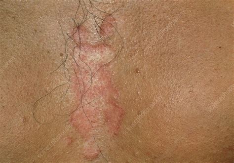 Close Up Of Seborrhoeic Dermatitis On The Chest Stock Image M140