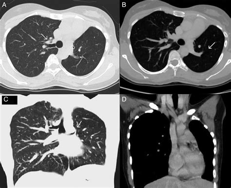 A Rare Case Of Coexisting Left Pulmonary Hypoplasia And Right Tracheal