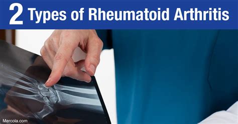 What Are The Types Of Rheumatoid Arthritis