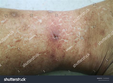 Closeup Eczema Atopic Dermatitis Symptom Infected Stock Photo
