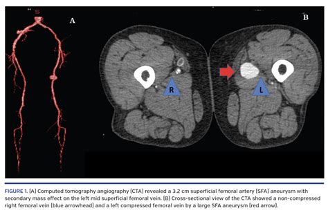 Superficial Femoral Artery Aneurysm As A Cause Of Deep Vein Thrombosis