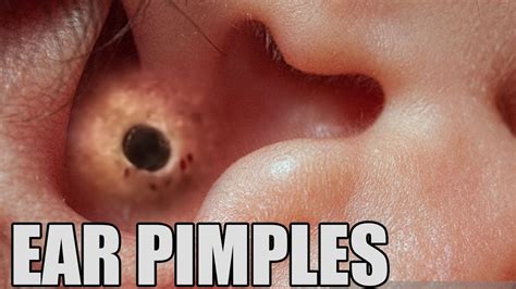 Ear Blackheads Pimples In The Ear Youtube