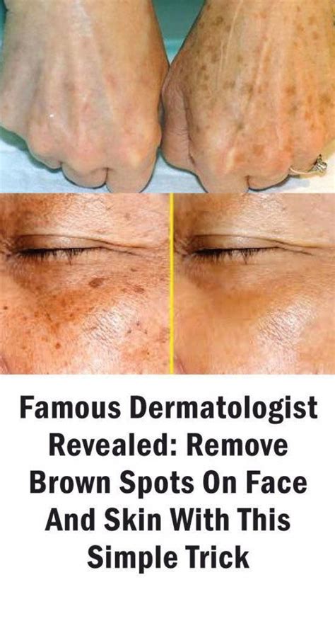 How To Get Rid Of Brown Spots On Confront Brownspotsonhands