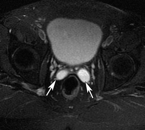 Imaging Of The Seminal Vesicle And Vas Deferens Radiographics