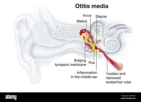 Medically Illustration Showing Inflammation Of The Middle Ear Otitis