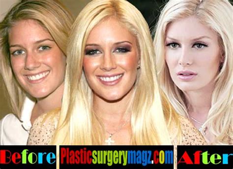 Heidi Montag Plastic Surgery Back Scoop Surgery Before And After Plastic Surgery Magazine