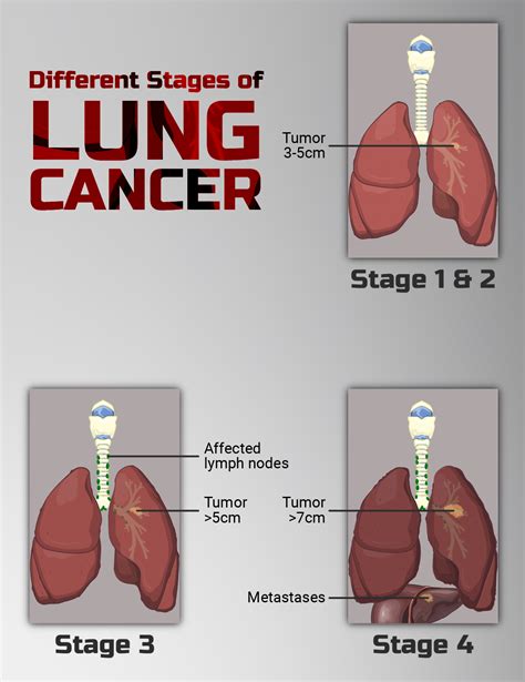 Why Is Lung Cancer So Difficult To Treat Surgeon Answers Scary Symptoms