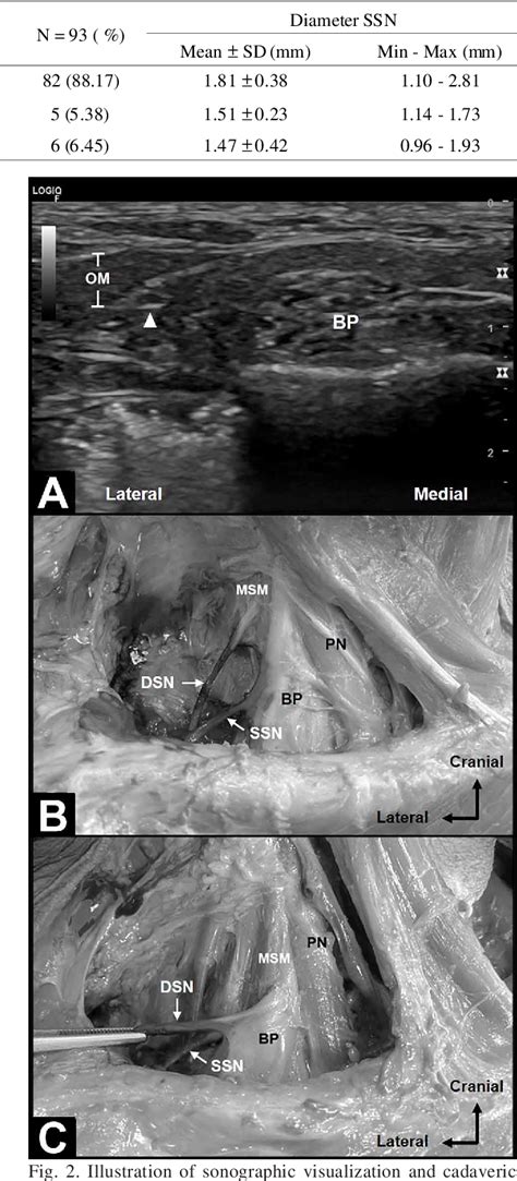 Figure 2 From Accuracy Of Sonographic Identification Of Suprascapular