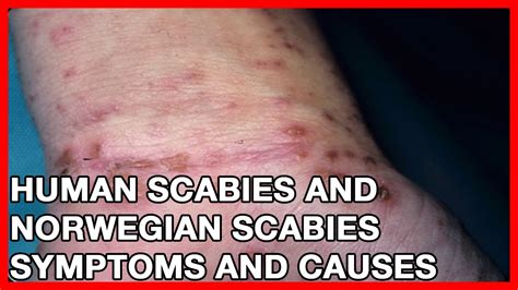 what are human scabies facts signs and remedies youtube