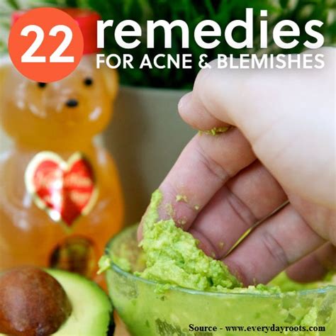 22 Home Remedies For Acne And Blemishes Home And Life Tips