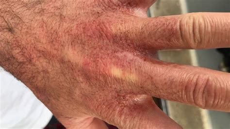 Customers Suffer Burns After Hand Gel Mixed Up With Drain Cleaner