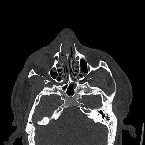 Normal Nasal Bone Ct Anatomy A Ct Scan In Coronal Plane Shows The