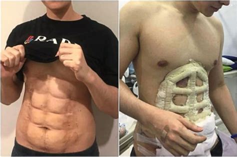 Hospital Offers Instant Six Pack Abs Surgery In Thailand Weirdnews
