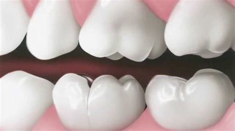 Fisura Dental ¿cuáles Son Los Síntomas Y Cómo Se Trata