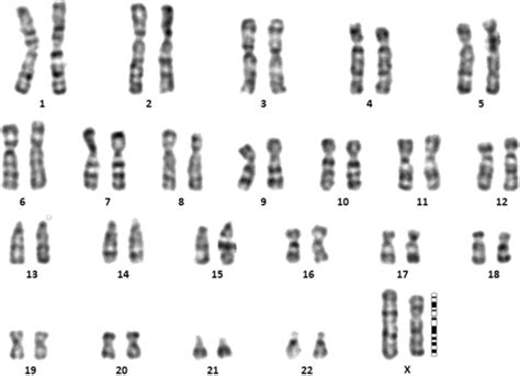 Representative Karyotype 46 XX I Xq Of A Primary Amenorrhea Female