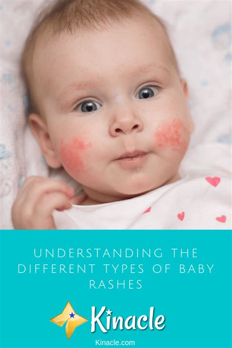 Understanding The Different Types Of Baby Rashes Kinacle