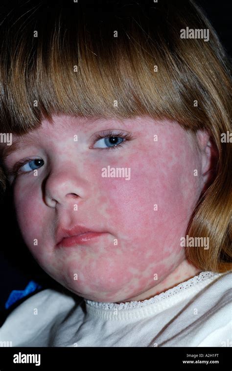 Allergic Reaction To Penicillin Hi Res Stock Photography And Images Alamy