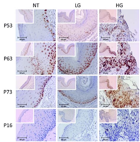 Immunohistochemical Staining Of The P53 P63 P73 And P16 Proteins In