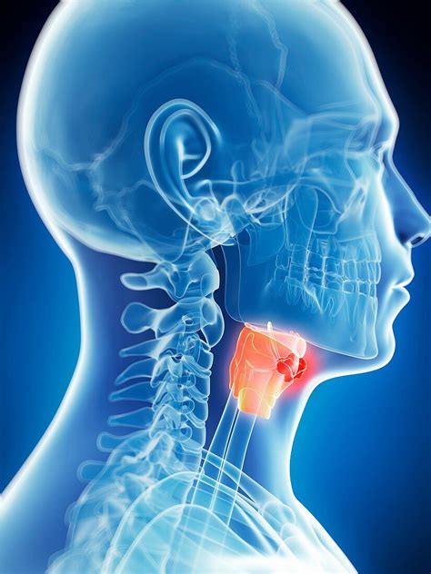 Human Larynx Tumor Artwork Bild Kaufen Science Photo Library