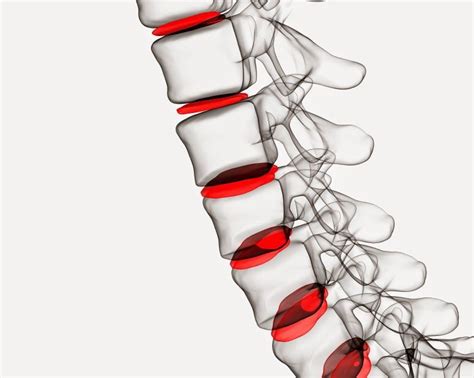 Cervical spine herniated disk surgery is not so common. What to Expect After Herniated Disc Surgery | Neck surgery, Surgery, Back surgery