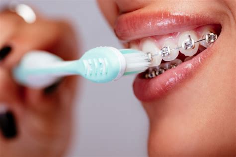 Brush Carefully After Having A Dental Brace Don T Let Food Get Trapped In Your Braces Consider