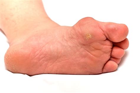 Corns Painless Removal At The Foot And Ankle Clinic