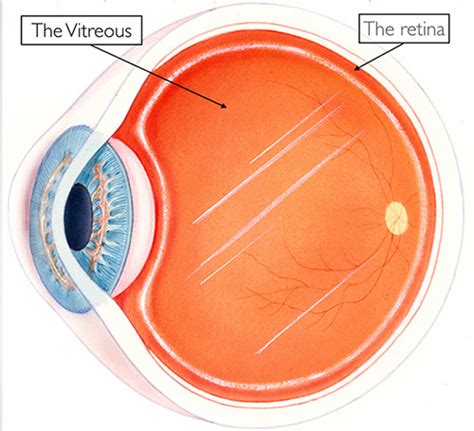 Posterior Vitreous Detachment And Floaters