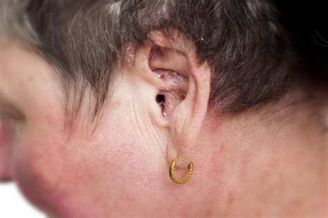 Ear Psoriasis Symptoms Causes And Treatment Miracle Ear