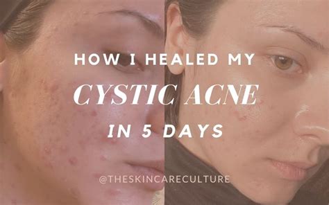 How I Healed My Cystic Acne In Five Days
