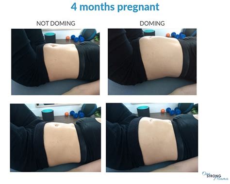 Diastasis Recti During Pregnancy Ryc®